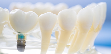 maxrisus_odontologia_implante_dental